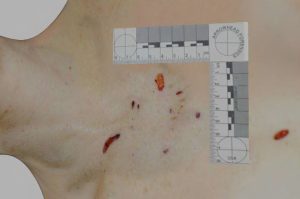 Ellen R Greenberg Autopsy Computer Model Chest