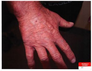 Barry Morphew Scratch marks