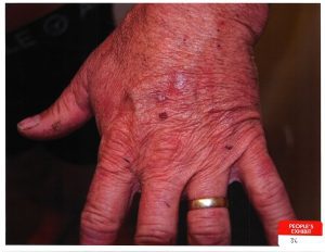 Barry Morphew Scratch marks